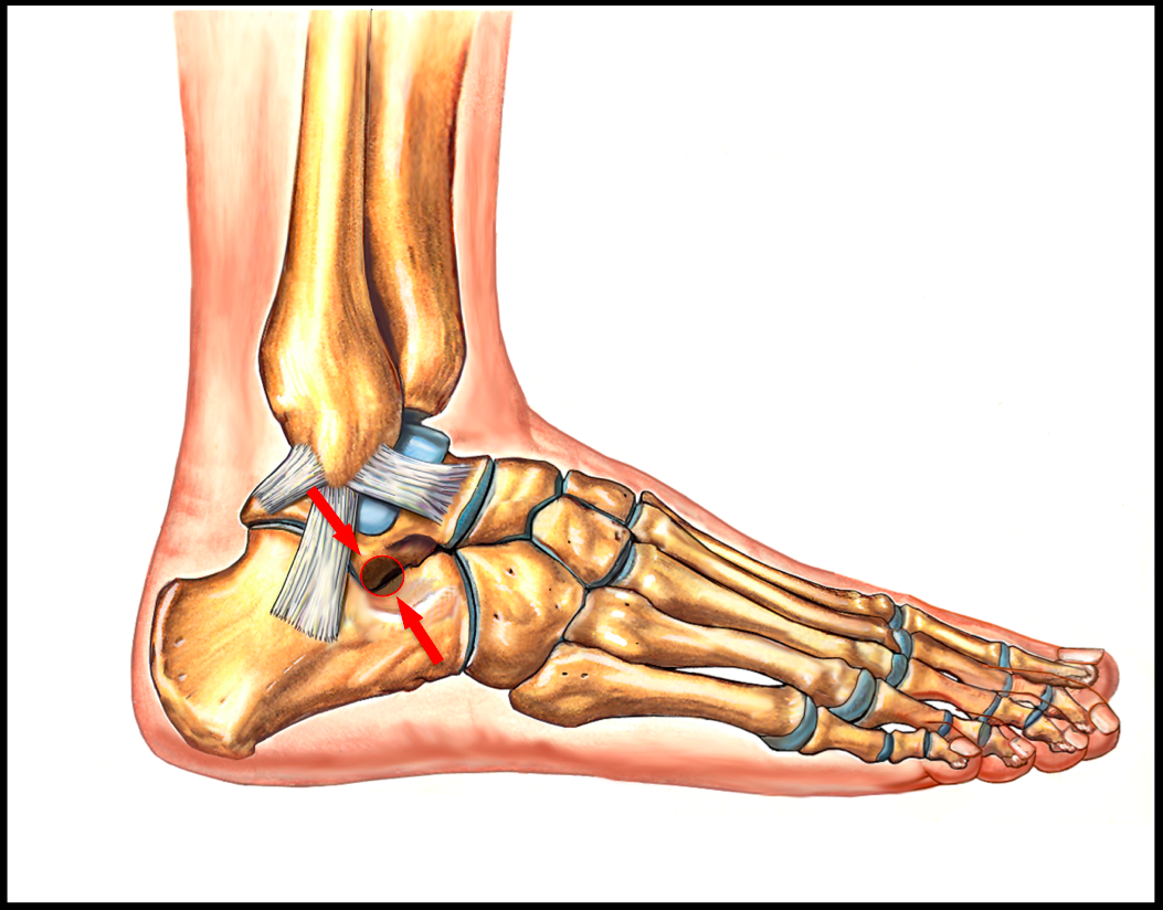 sinus-tarsi-syndrome-footeducation