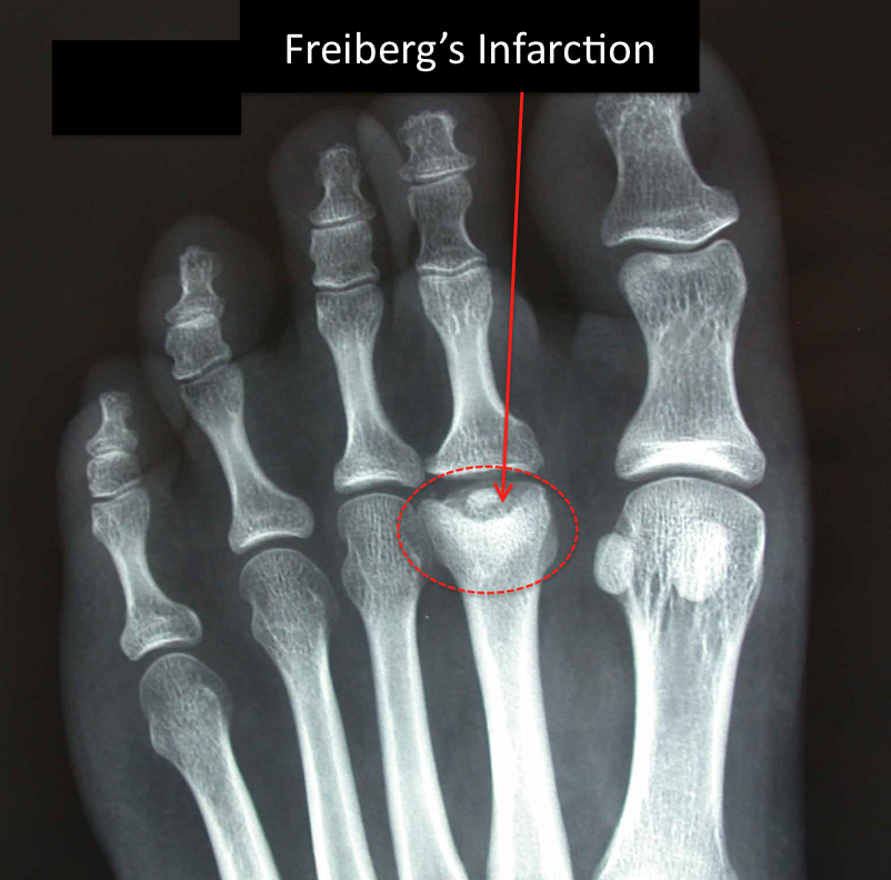 Freiberg S Disease Footeducation