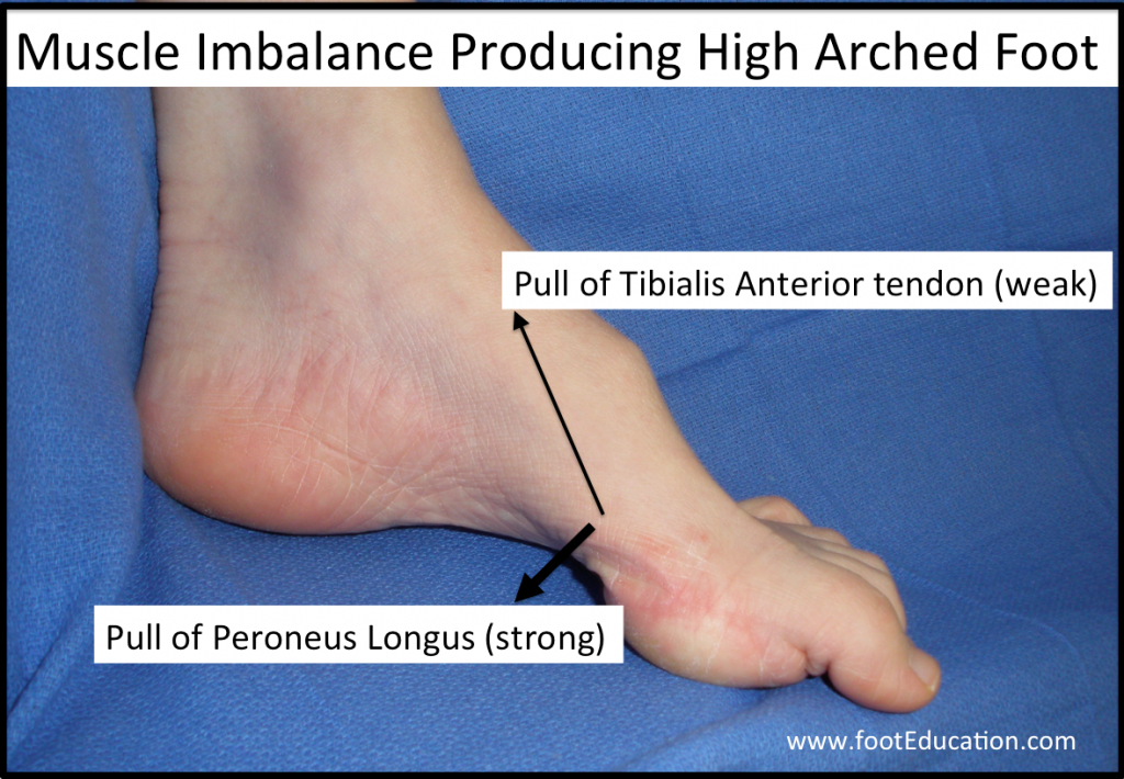 Charcot Marie Tooth Disease Foot Deformities Footeducation