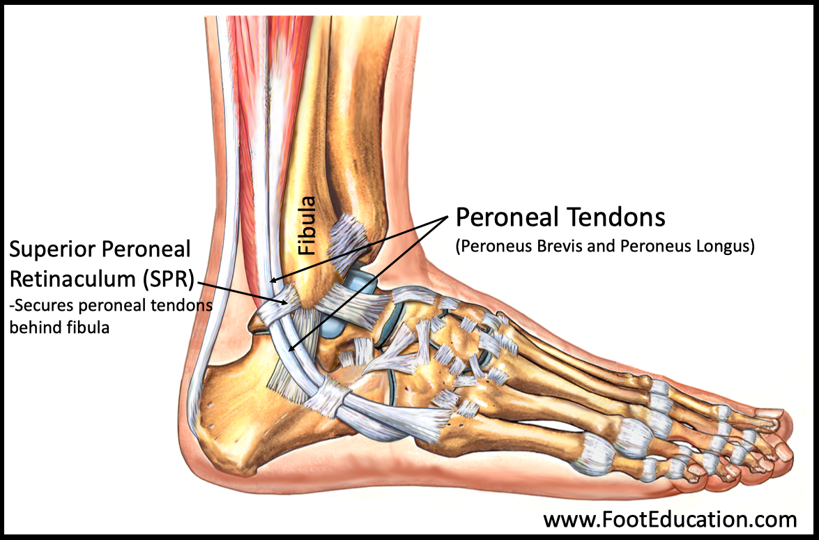 chronic-peroneal-tendon-subluxation-footeducation