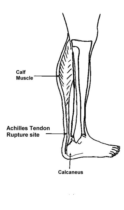 Understanding Achilles Tendon Ruptures Footeducation