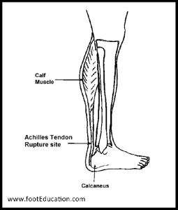 The Achilles Tendon Muscle and rupture site