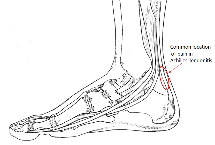 Common location of Achilles Tendonitis pain