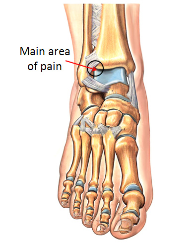 Anterolateral Ankle Impingement Typical Location of Pain