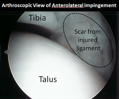 Arthroscopic View of Scarred Ligament