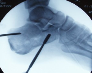 Calcaneus following percutaneous repair