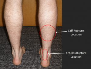 Typical Location of Calf Tear vs Achilles Tendon rupture