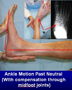 Compensatory motion through the joints in front of the ankle joint