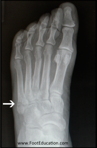 Fifth metatarsal base avulsion fracture x-ray