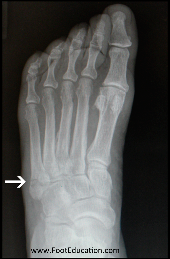 Weeks foot walking 4 broken after on Fibula Fracture