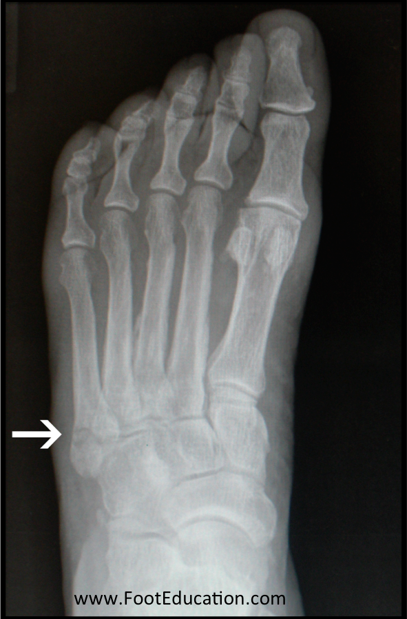 base of fifth metatarsal fracture