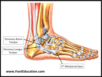 Flexor Hallucis Longus Tendon Transfer to the Peroneus Brevis ...