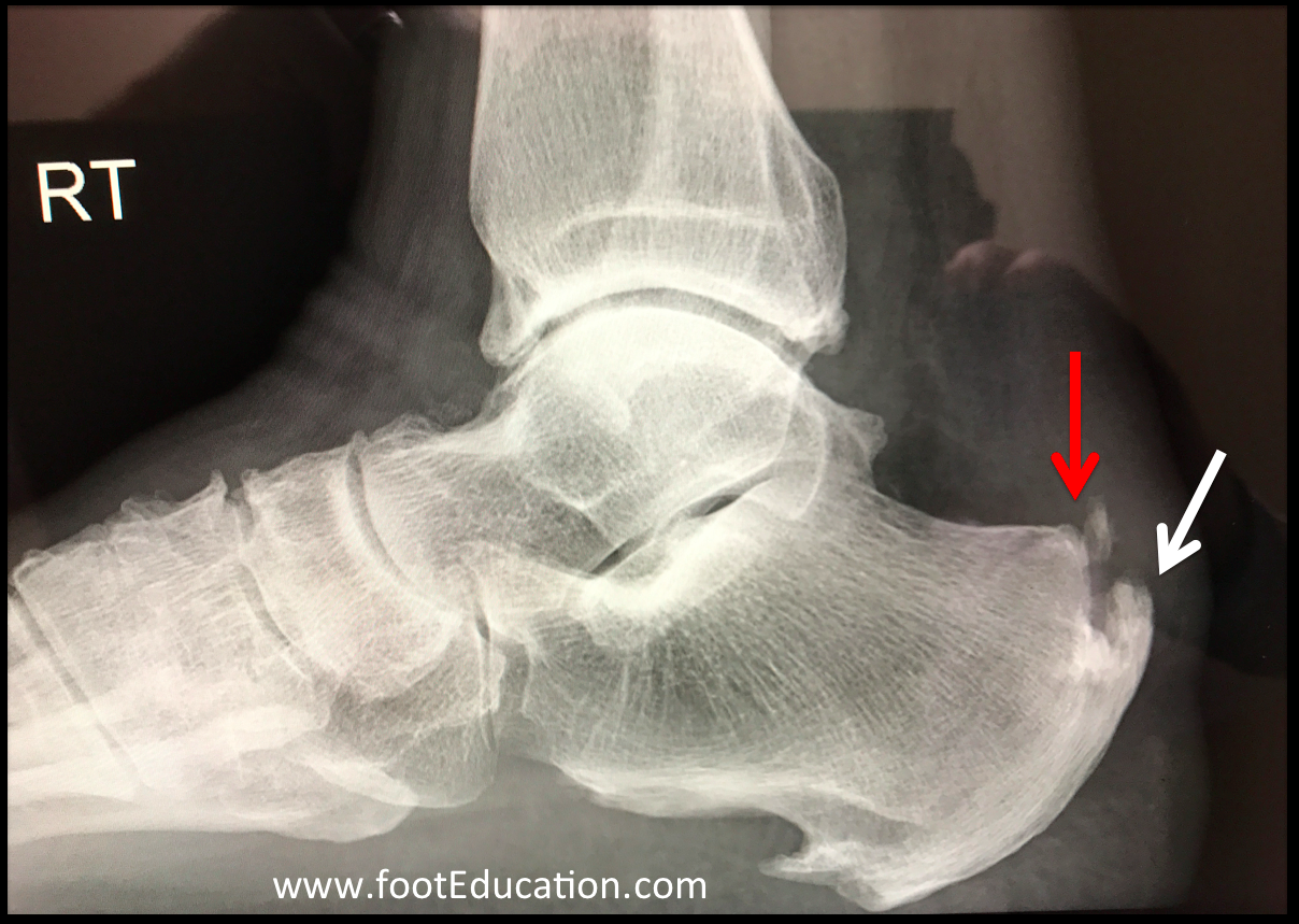 Posterior Heel Pain FootEducation
