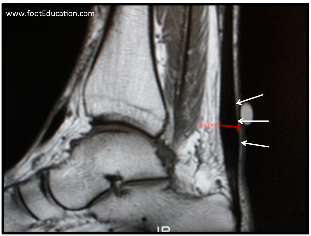 MRI showing swelling associated with classic Achilles tendonitis.