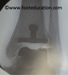 Tornier Salos Talaris Total Ankle Replacement