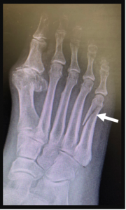 5th Metatarsal Shaft