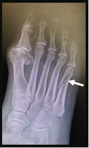 Foot after on weeks 4 walking broken Metatarsal fracture
