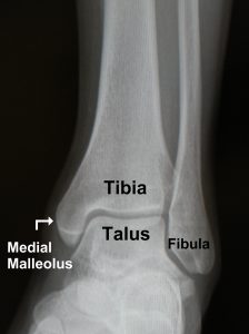 Normal Ankle x-ray