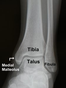 Ankle Fracture - FootEducation