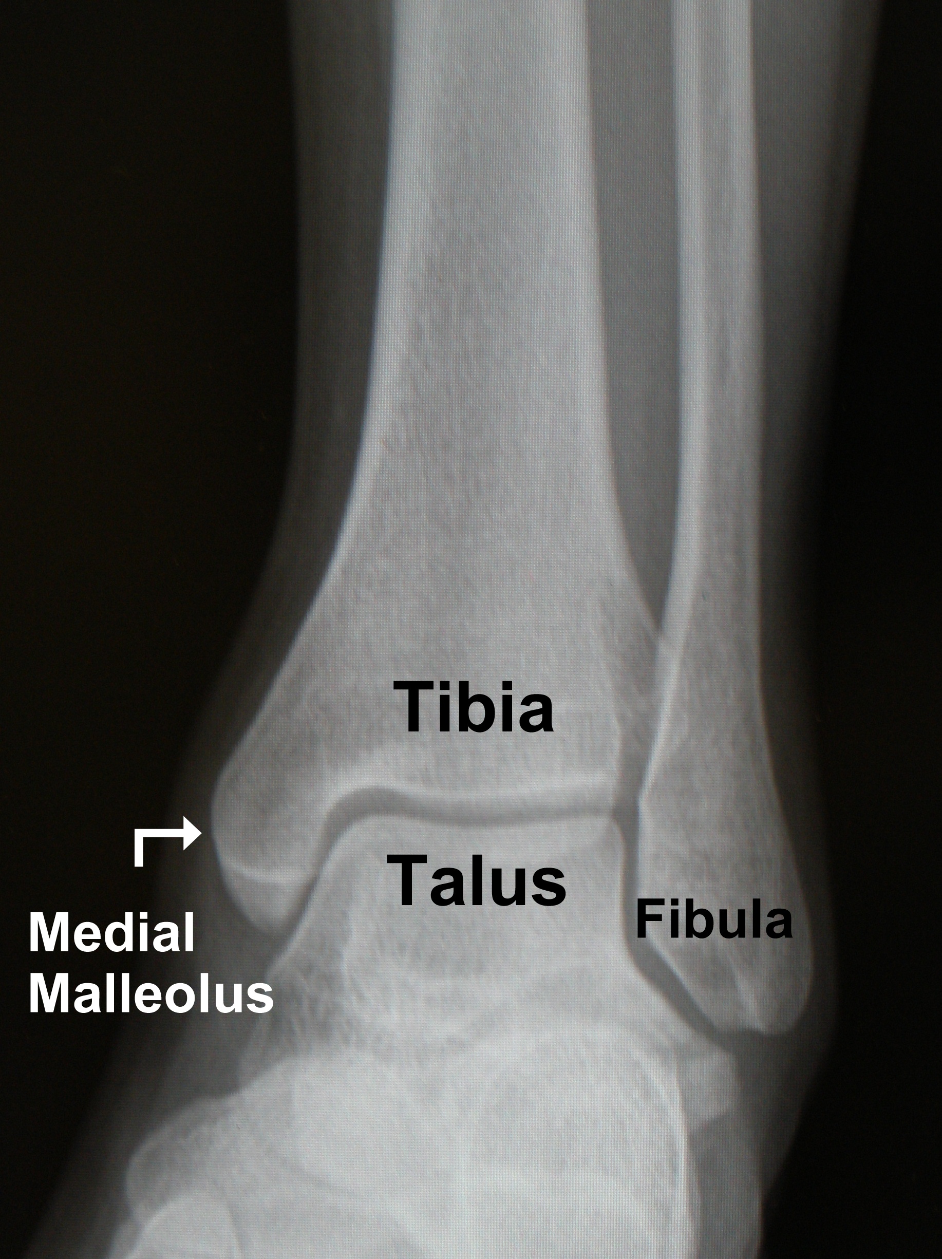 medial malleolus of tibia