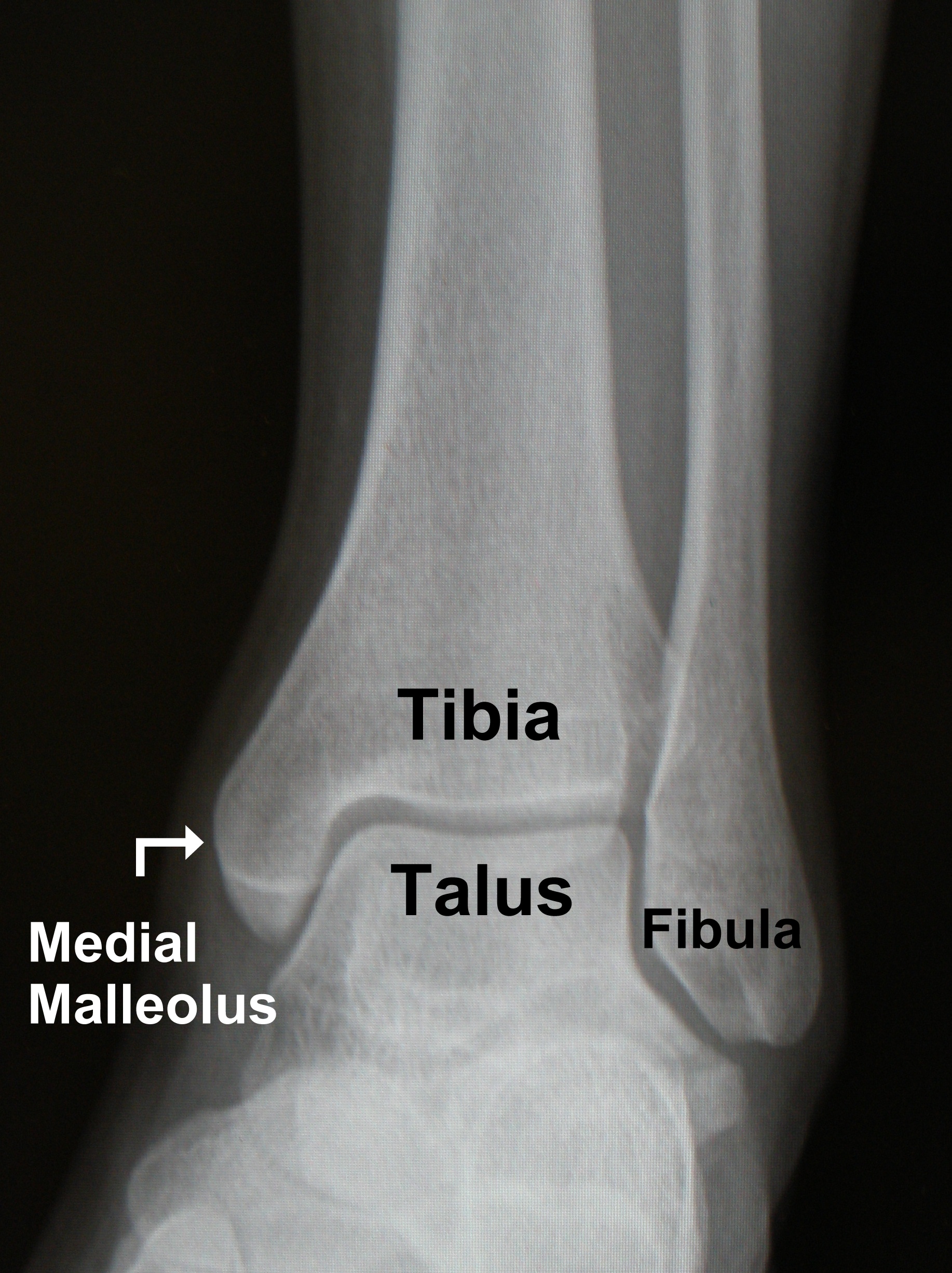 fractured ankle x ray