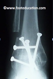Ankle Joint Fusion (Arthrodesis) on xray