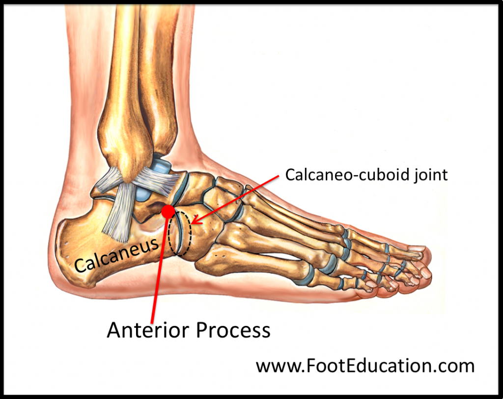 Anterior Process Fracture Of The Calcaneus FootEducation   Figure 1 Anterior Process Of The Calcaneus 1024x813 