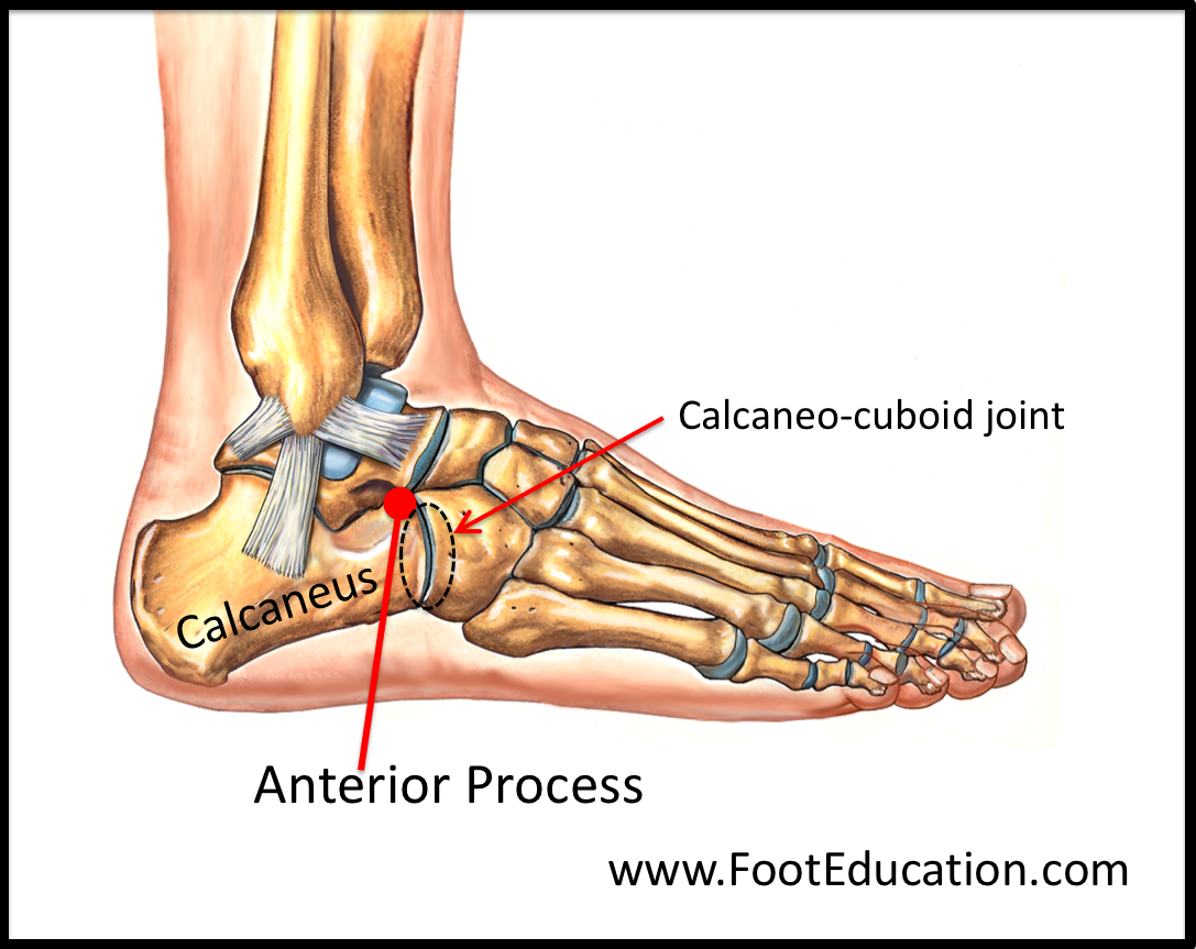 Rostre Du Calcaneum Fracture Du Calcan um Dur e AQNY Rostre Du Calcaneum Fracture Du Calcan um Dur e AQNY