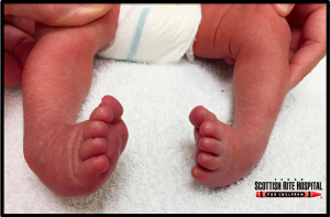 Bilateral clubfoot in a newborn with characteristic equinus and varus deformities. (Courtesy of Steve Richards MD, Texas Scottish Rite Hospital)