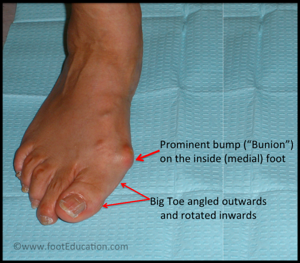 5 Common Big Toe Problems Footeducation