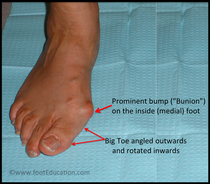 Side of deals big toe pain