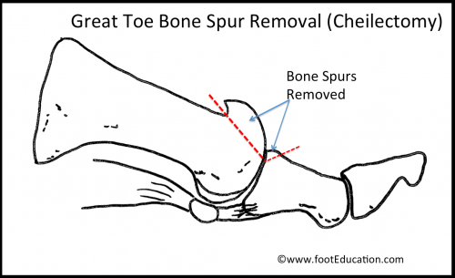 Great Toe Cheilectomy (bone spur removal) for treatment of mild Hallux Rigidus (arthritis of great toe)