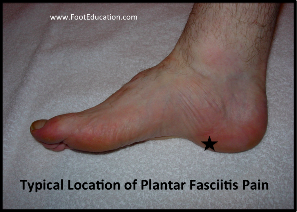 Plantar Fasciitis FootEducation   Figure 1 Common Location Of Plantar Fascia Pain 1024x730 