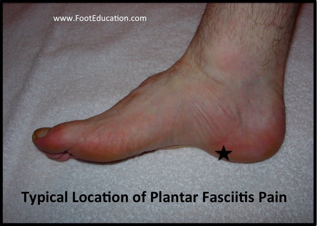 plantar fasciitis cause ankle pain