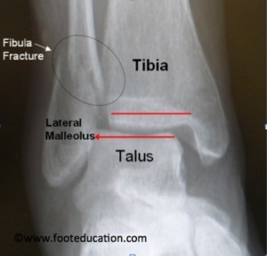 Displaced fibular fracture with displaced ankle joint