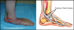 Acquired Adult Flatfoot Deformity - FootEducation