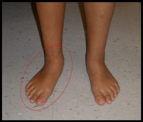 icd 10 code for tarsal coalition of left foot