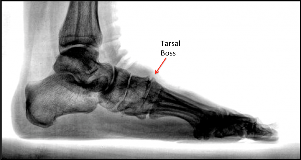 Tarsal Boss Footeducation