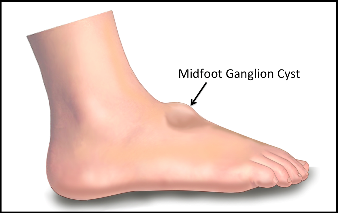 Ganglion Cysts Footeducation
