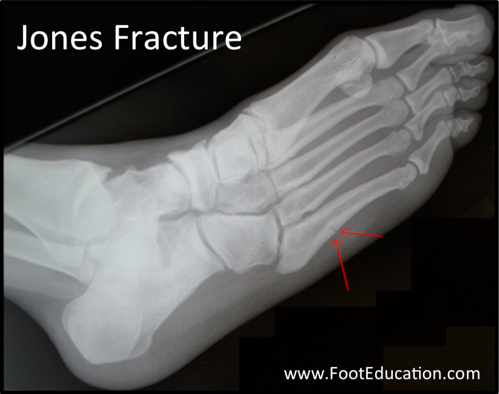 Jones Fracture Footeducation 7249