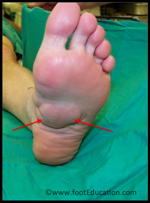 Plantar Fibroma Footeducation