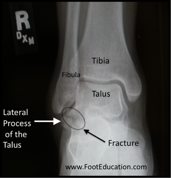  Talar Process Fractures 