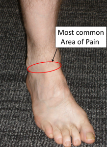 Location of Pain in Anterior Ankle Impingement