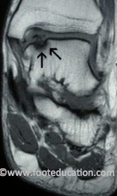 MRI of Medial (Inside) Talar OLT