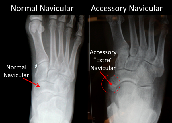 Normal Navicular compared to "Accessory" Navicular shown on x-ray