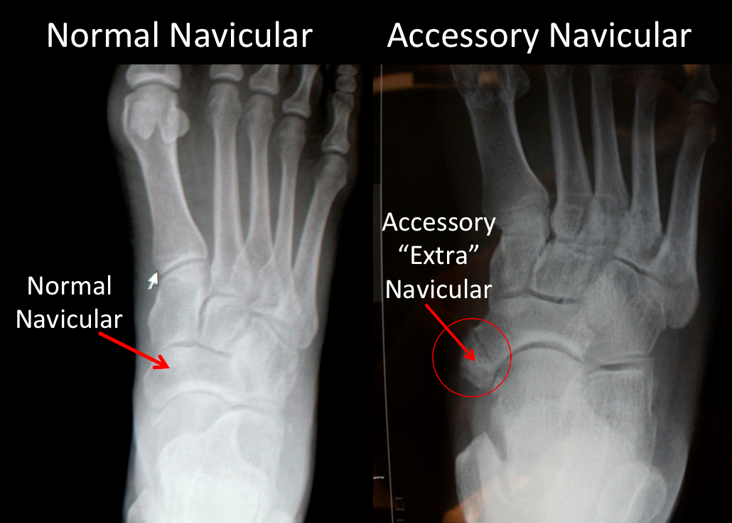 Accessory Navicular Bone - FootEducation
