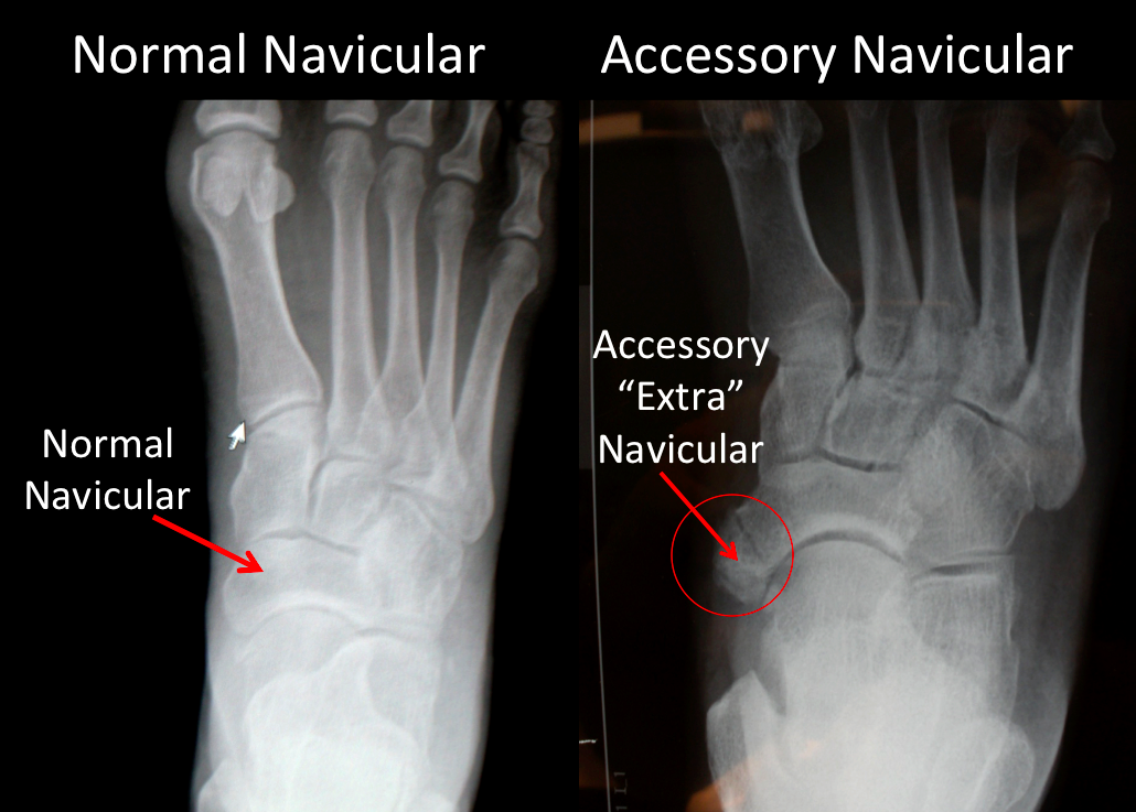 Accessory Navicular Xray At Beth Heard Blog Accessory Navicular Xray At Beth Heard Blog