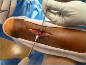Open repair of Achilles tendon rupture