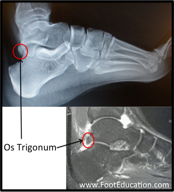 Os Trigonum (circled in red) on plain ankle x-ray (top) and MRI (bottom).