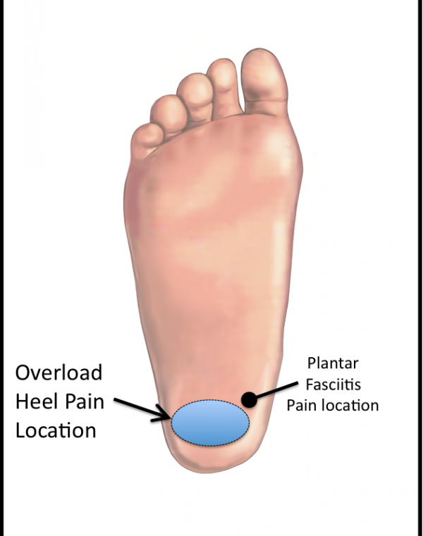 Overload Heel Pain Location of Symptoms